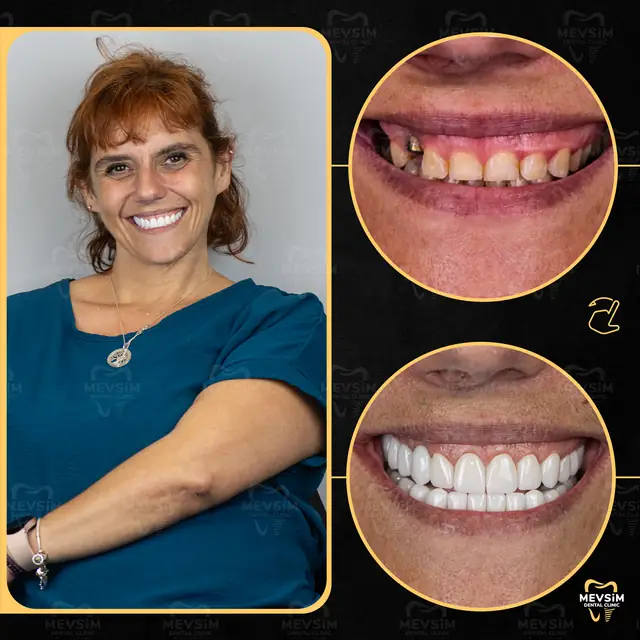 Patient 2: smile before and after treatment at Mevsim Dental Clinic