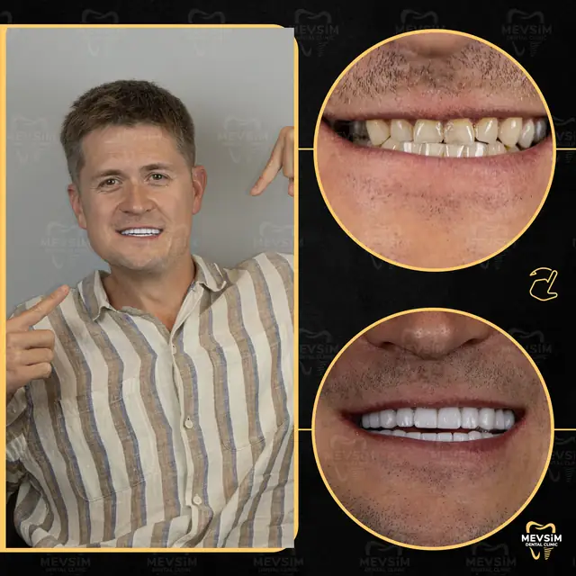 Patient 7: smile before and after treatment at Mevsim Dental Clinic