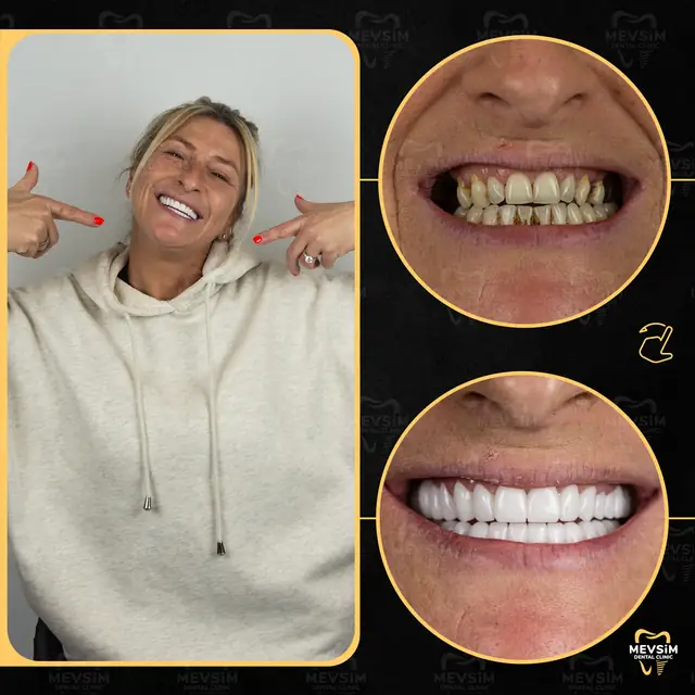 Patient 3: smile before and after treatment at Mevsim Dental Clinic