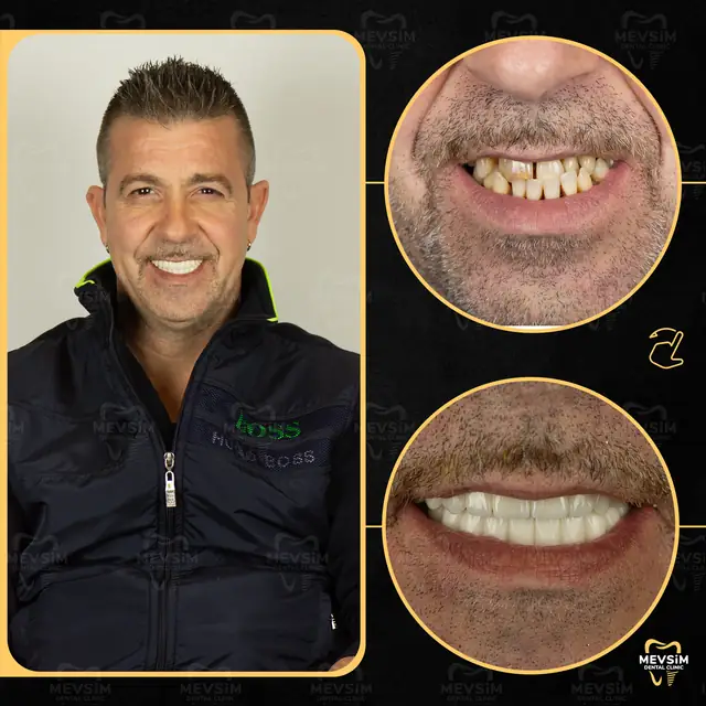 Patient 9: smile before and after treatment at Mevsim Dental Clinic