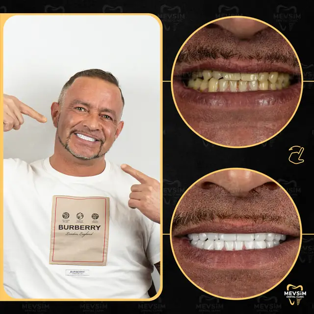 Patient 5: smile before and after treatment at Mevsim Dental Clinic